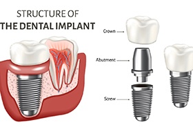 illustration showing the parts of a dental implant 