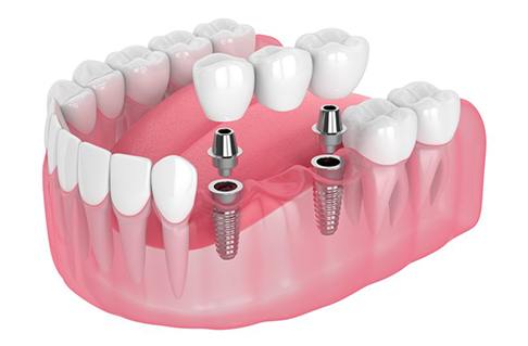 Exploded illustration of traditional dental bridge
