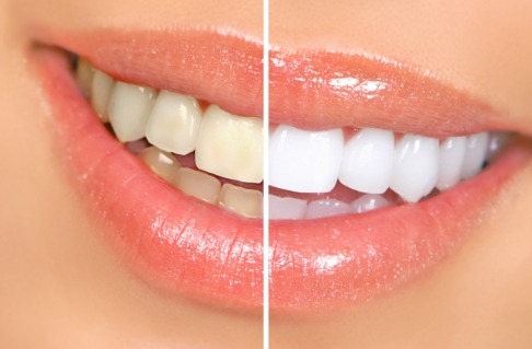 Smile before and after teeth whitening