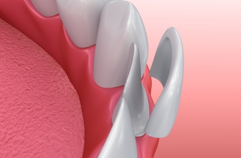 Animated smile during porcelain veneer placement