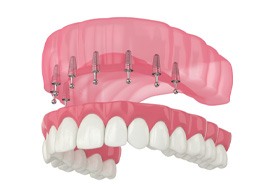 Implant dentures in Framingham     