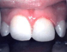 Closeup of repaired top front tooth