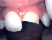 Closeup of broken top front tooth