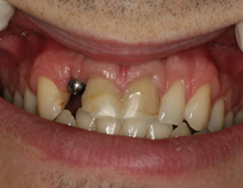 Smile with dental implant post visible before tooth replacement