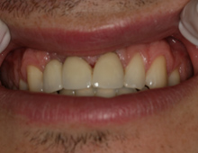 Smile after tooth replacement