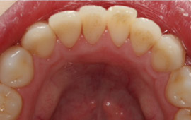 Aligned bottom teeth after orthodontic treatment