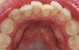 Crooked bottom teeth before orthodontic treatment