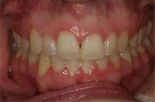 Perfectly aligned smile after orthodontic treatment