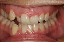 Misaligned smile before orthodontic treatment