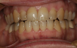 Overbite corrected after orthodontic treatment