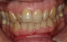 Smile with overbite before orthodntic treatment