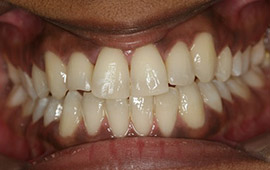 Bright smile after teeth whitening from the skilled cosmetic dentist