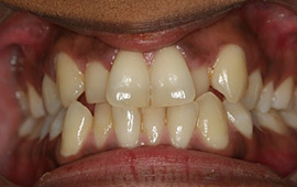 Yellowed smile before cosmetic dentistry