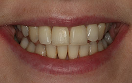 Perfected smile after cosmetic dentistry