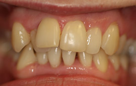 Severely discolored and misaligned smile before cosmetic dentistry