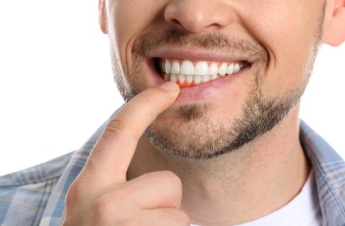 Man pointing to smile before gum disease treatment