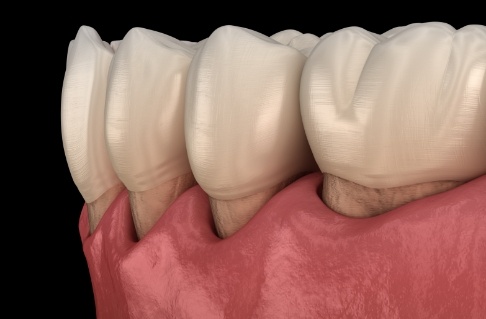 Animated smile in need of scaling and root planing treatment