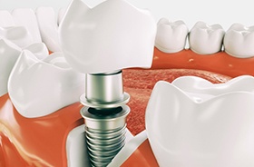 Parts of a dental implant