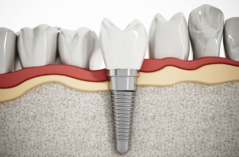 Animated smile with dental implant supported dental crown