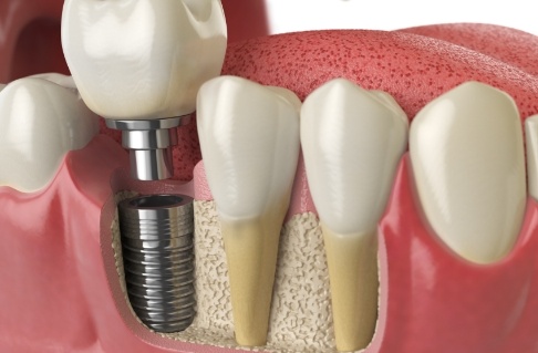 Animated smile during dental implant replacement tooth placement