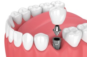 Animated smile during dental implant supported dental crown placement