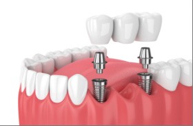 Animated smile during dental implant supported fixed bridge placement