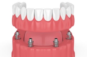 Animated smile during dental implant supported denture placement