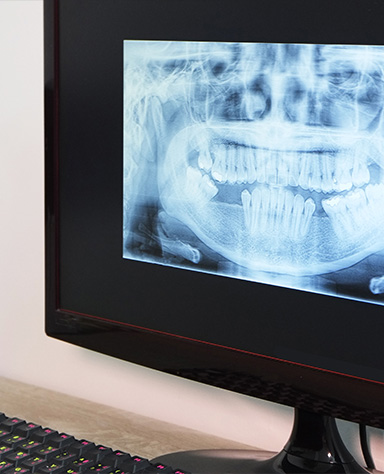 Digital dental x-rays