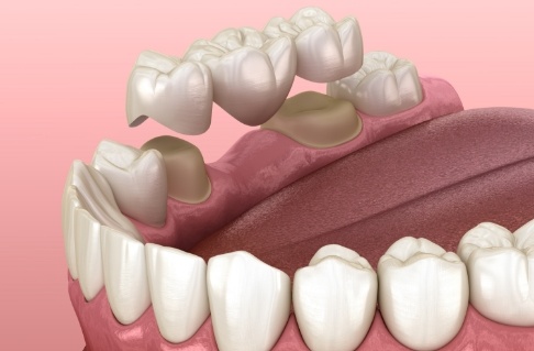 Animated smile during dental bridge placement