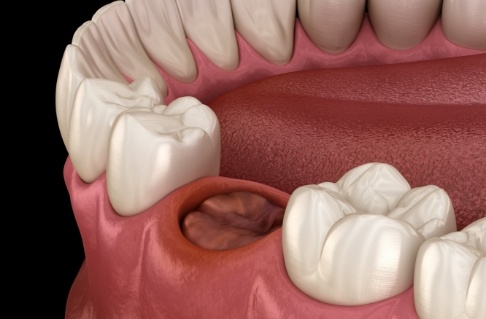 Animated smile with single missing tooth