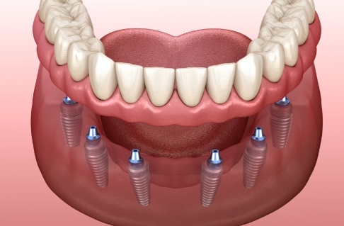 Animated smile during dental implant supported denture placement