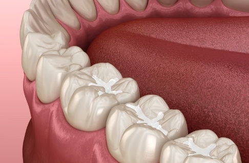 Damaged teeth in need of custom nightguard for teeth grinding