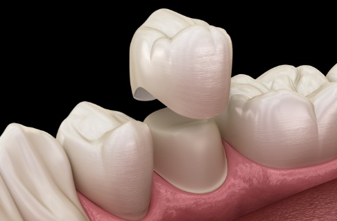 Animated smile during dental crown placement