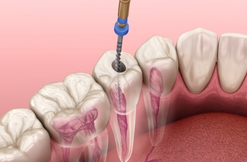 Animated smile during root canal therapy