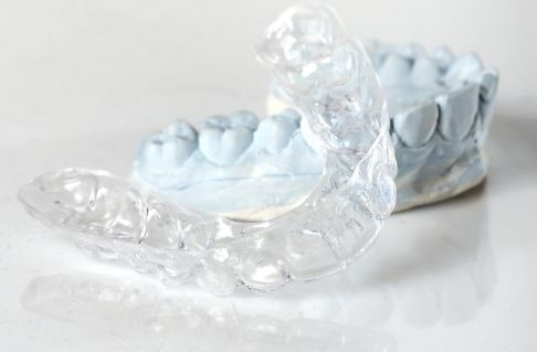 Orthodontic aligner crafted using the digital impressions system