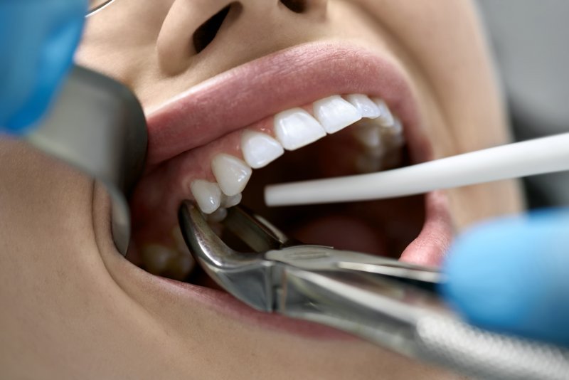 closeup of tooth extraction in Framingham