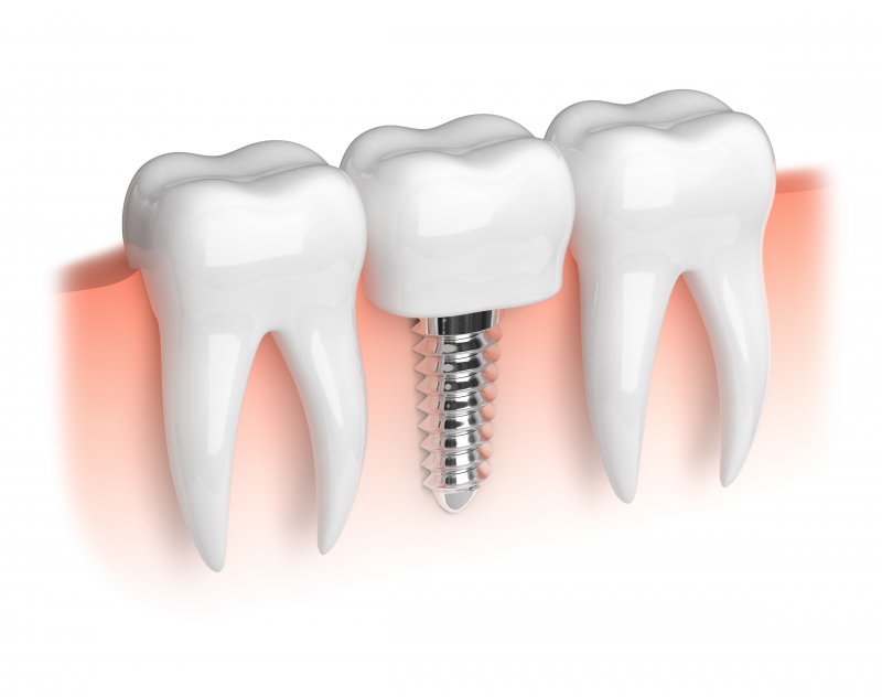 3-D model of a dental implant