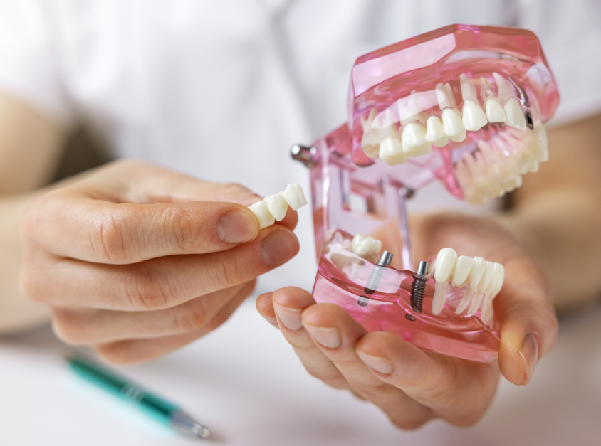 Model dental bridge